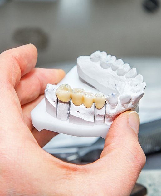 Dental bridge on clay model