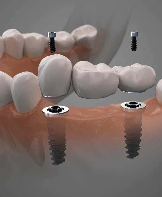 Digital illustration of implant bridge