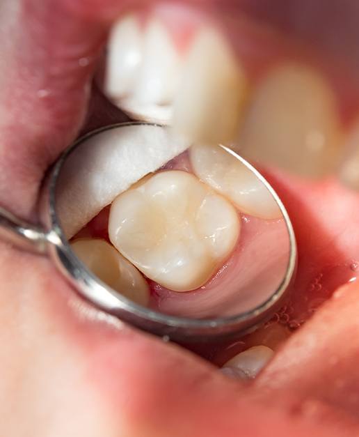 Closeup of smile after tooth colored filling restorative dentistry