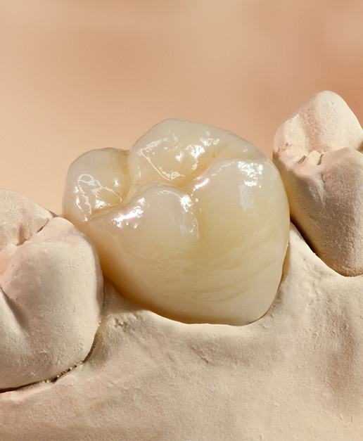 Model smile with dental crown restoration