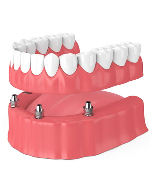 Animated dental implant supported denture