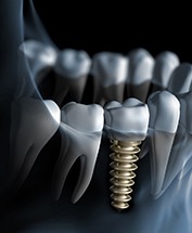 a digital illustration depicting and implant crown