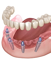 a 3D illustration showing dental implants replacing an entire arch 