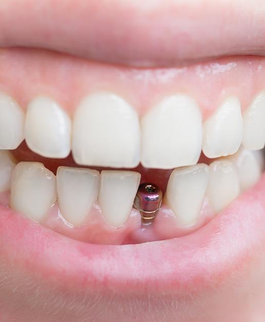 Closeup of smile with dental implant post visible