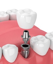 Animated smile during dental implant supported dental crown placement