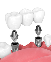 Animated smile during dental implant supported fixed bridge placement