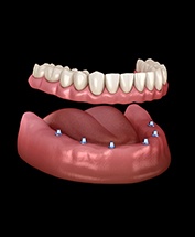 Animated smile after dental implant supported denture placement