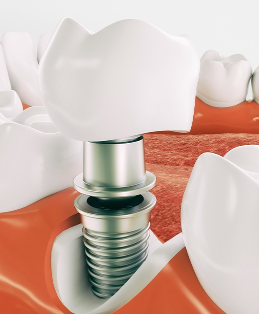 Animated smile showing dental implant components