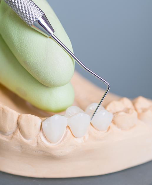 Model of dental bridge used to replace missing teeth