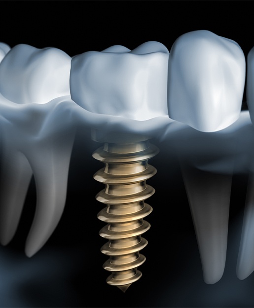 Animated smile with dental implant supported dental crown