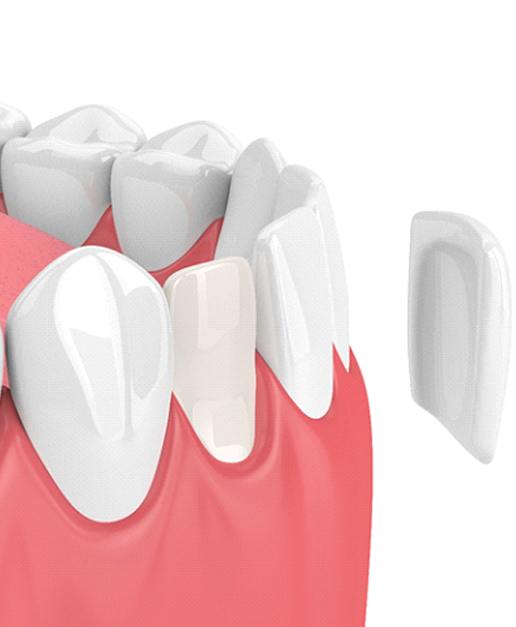 Model of a dental veneer