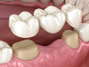 Render of a dental bridge placed on abutment teeth